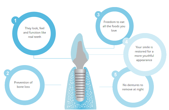 Five reasons for dental implants