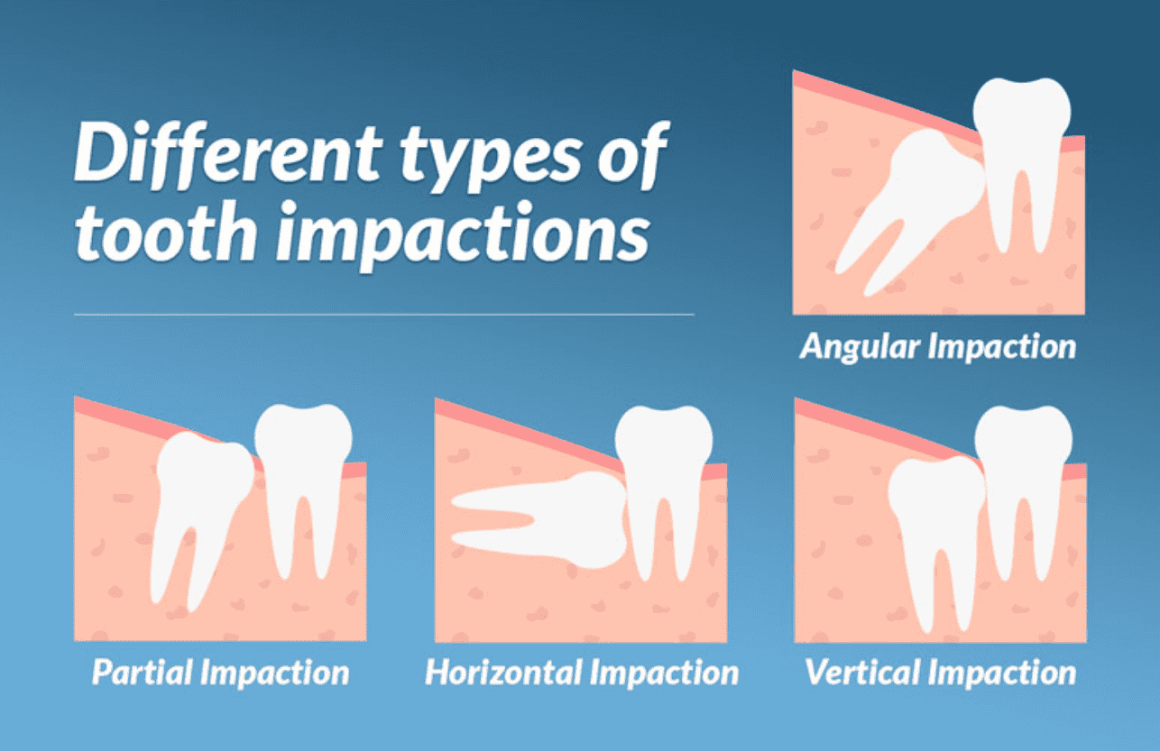 Tooth impactions