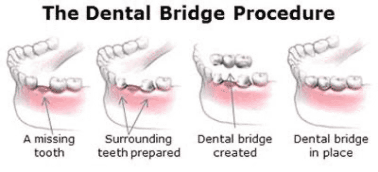 Dental bridge procedure