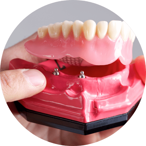 Implant Denture Hero Image