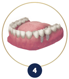 permanent tooth replacement
