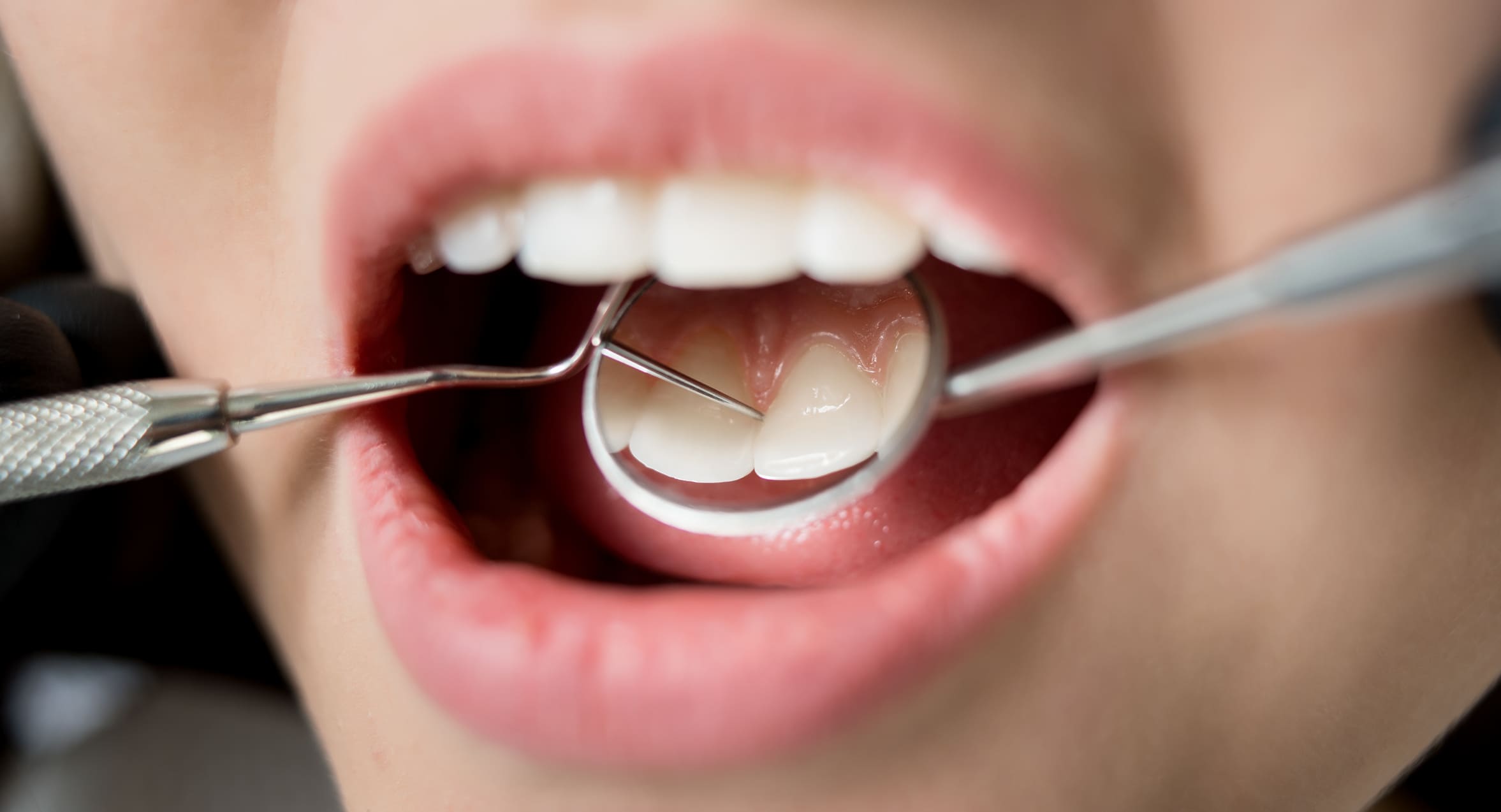 Preventing Dental Emergencies Beyond Brushing and Flossing