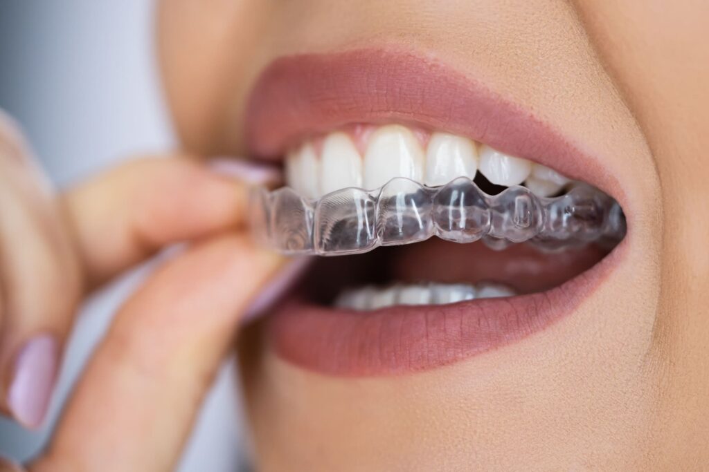 The Benefits of Invisalign: A Modern Approach to Straightening Teeth ...