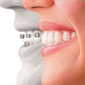 Invisalign for Teenagers